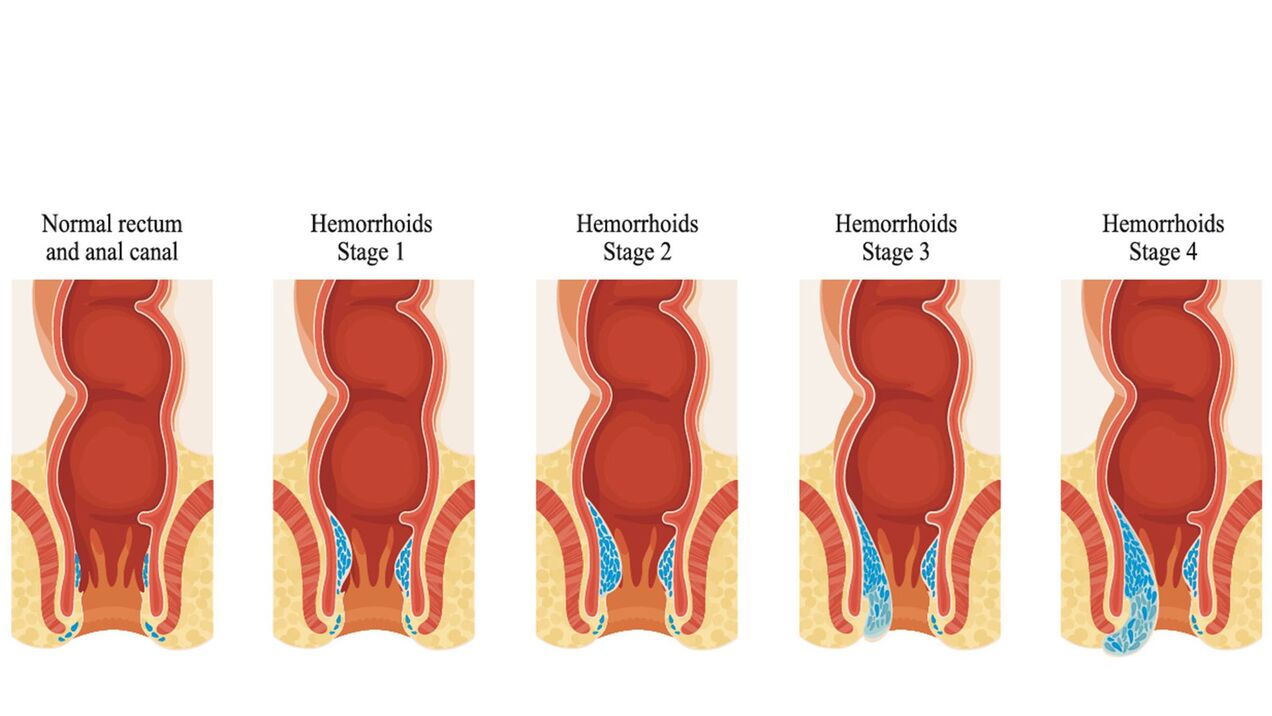 Tipos de hemorróidas